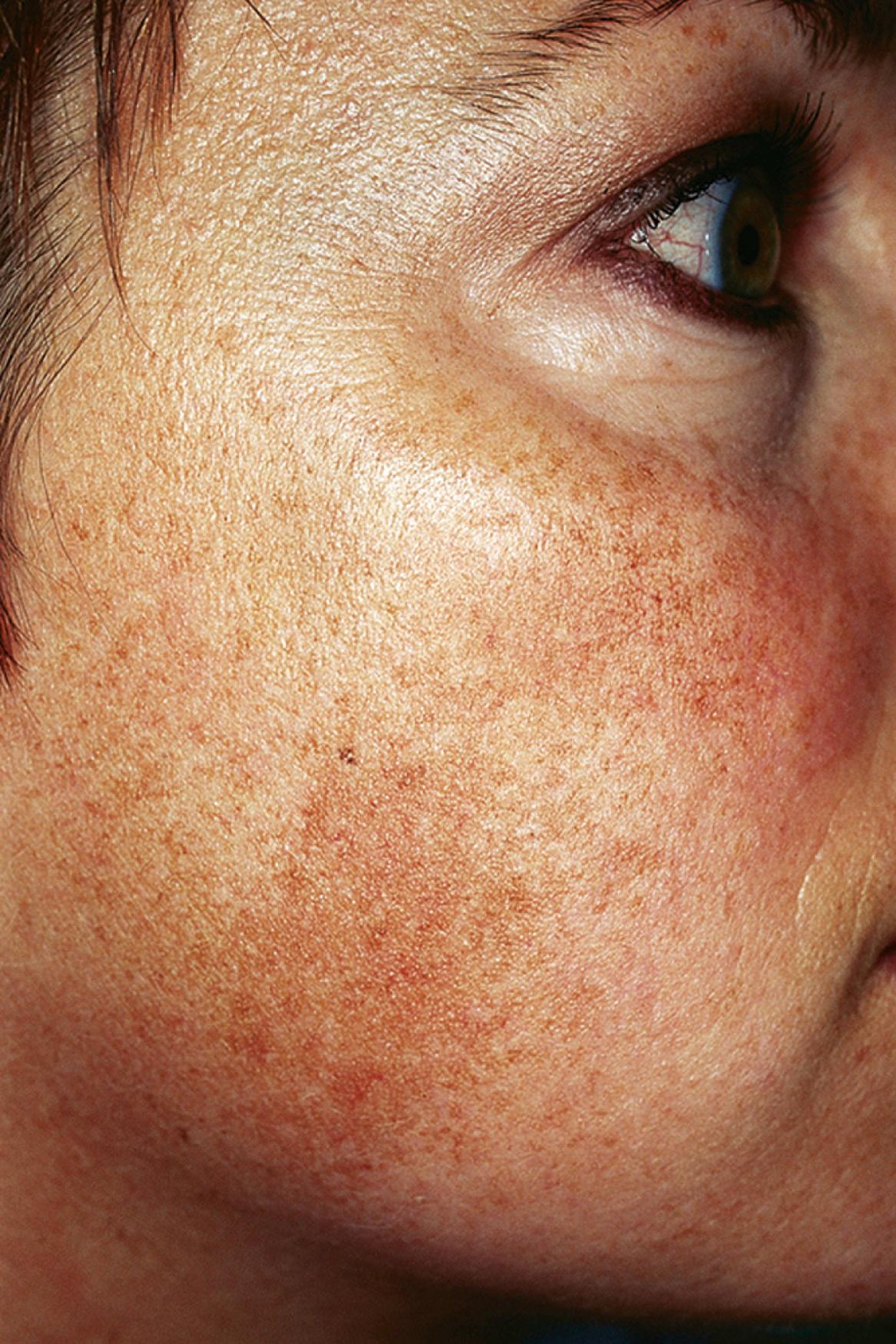 Fig. 9.6, Facial hyperpigmentation: chloasma (melasma).