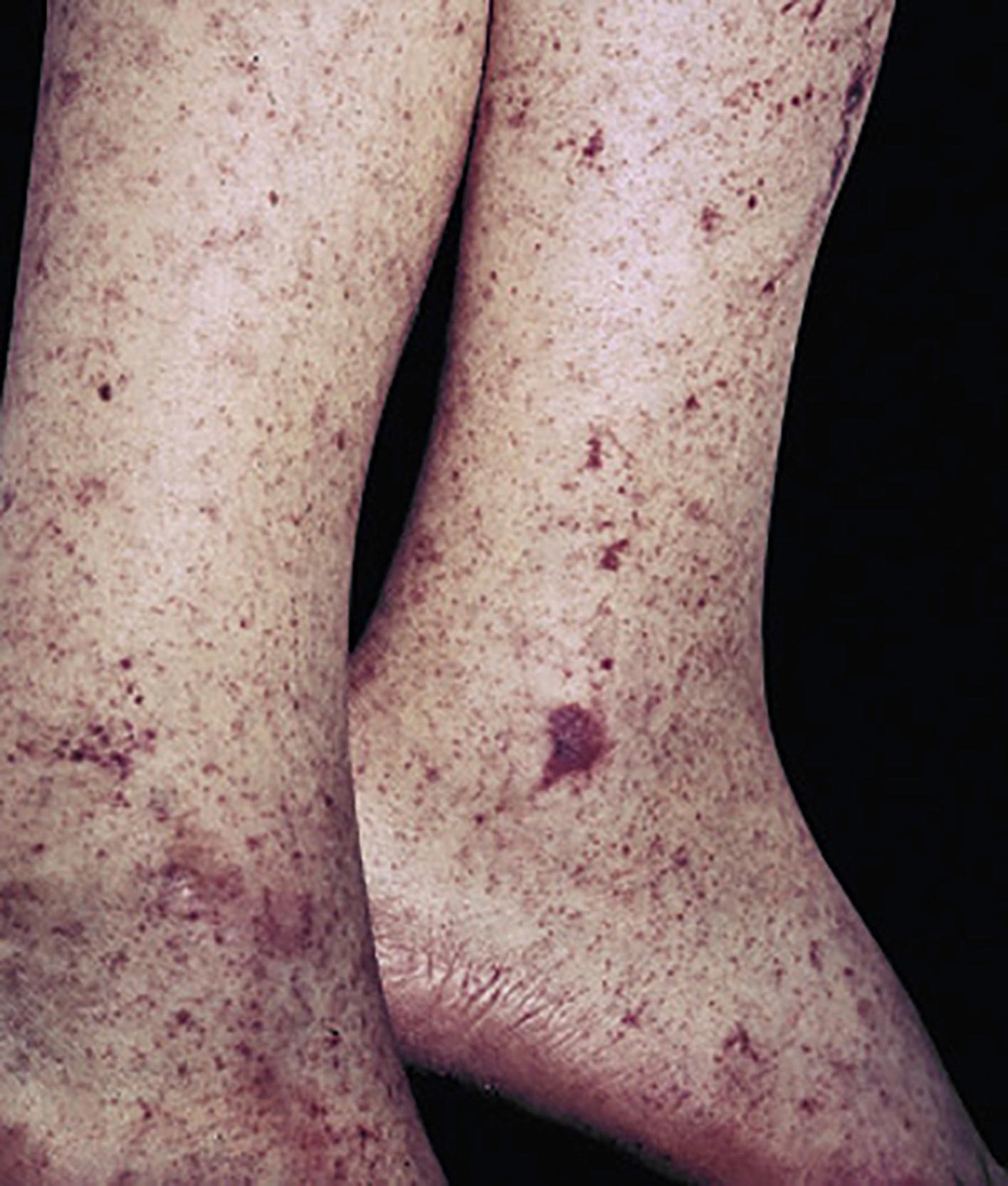 Fig. 9.8, Petechiae.