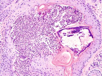 Figure 20.1, Bacterial folliculitis.