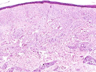 Figure 20.12, Lepromatous leprosy.