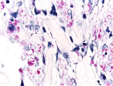 Figure 20.14, Lepromatous leprosy (Wade-Fite stain).