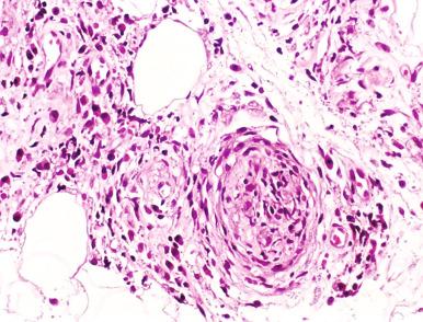 Figure 20.15, Lepromatous leprosy—subpolar lepromatous leprosy.