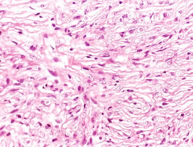 Figure 20.17, Histoid leprosy