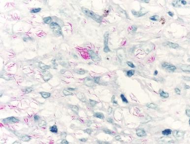 Figure 20.18, Histoid leprosy (Wade-Fite stain).