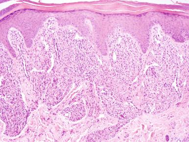 Figure 20.19, Borderline lepromatous leprosy.