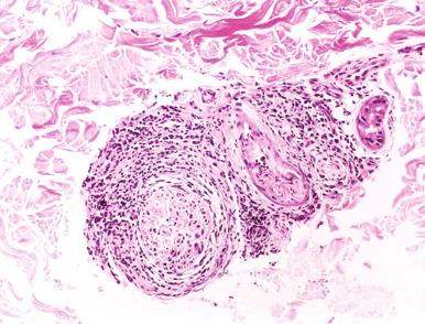 Figure 20.20, Borderline lepromatous leprosy.