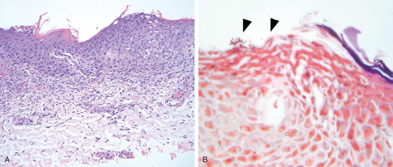 Figure 20.2, Impetigo.