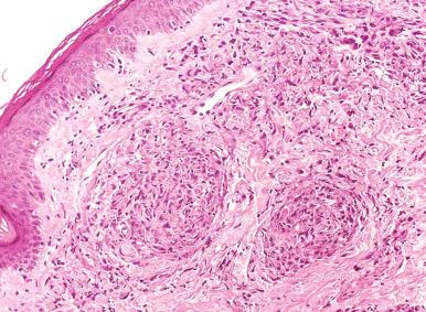 Figure 20.21, Mid-borderline leprosy.