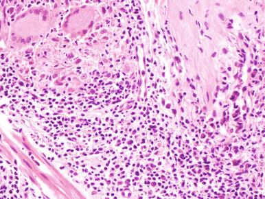 Figure 20.23, Borderline tuberculoid leprosy.