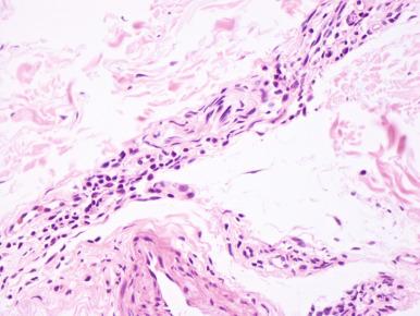 Figure 20.26, Tuberculoid leprosy.