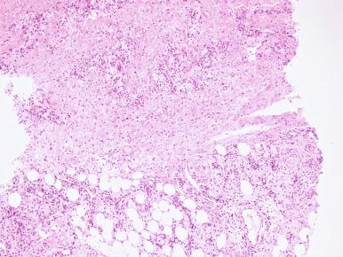 Figure 20.27, Erythema nodosum leprosum.