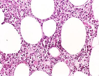 Figure 20.28, Erythema nodosum leprosum.