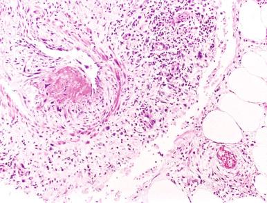 Figure 20.29, Erythema nodosum leprosum.