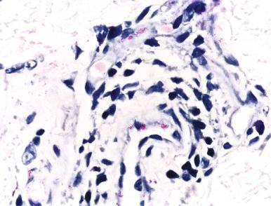 Figure 20.31, Lucio phenomenon (Wade-Fite stain).