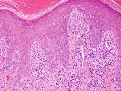 Figure 20.33, Secondary syphilis.