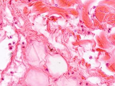 Figure 20.5, Cutaneous anthrax.