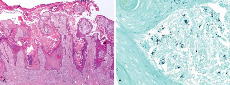 Figure 20.8, Cutaneous nocardiosis.