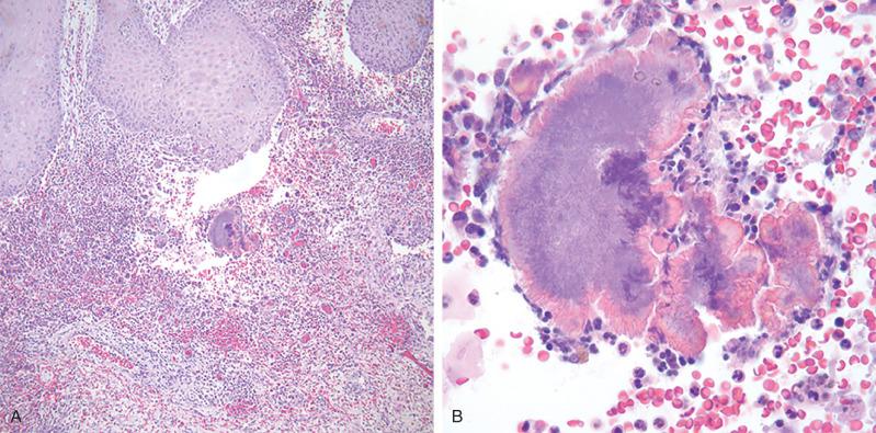 Figure 20.9, Actinomycosis.