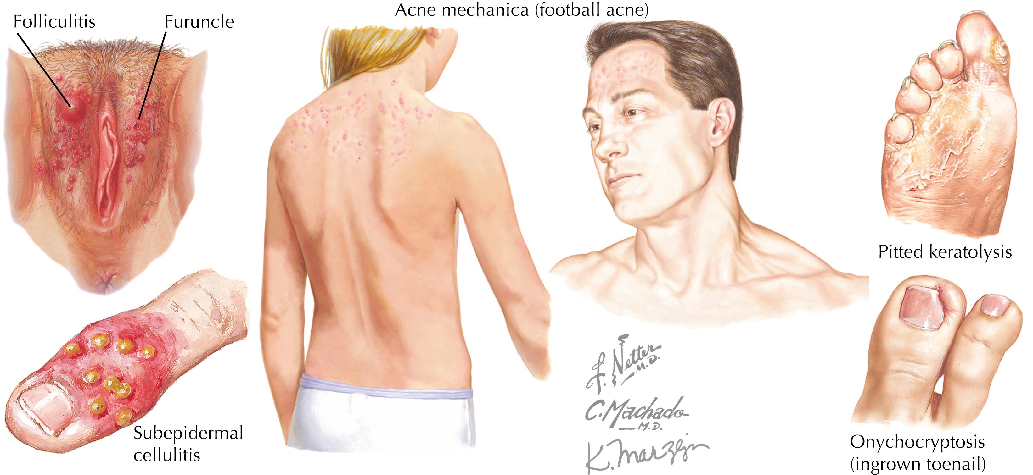 Figure 40.2, Common bacterial infections.