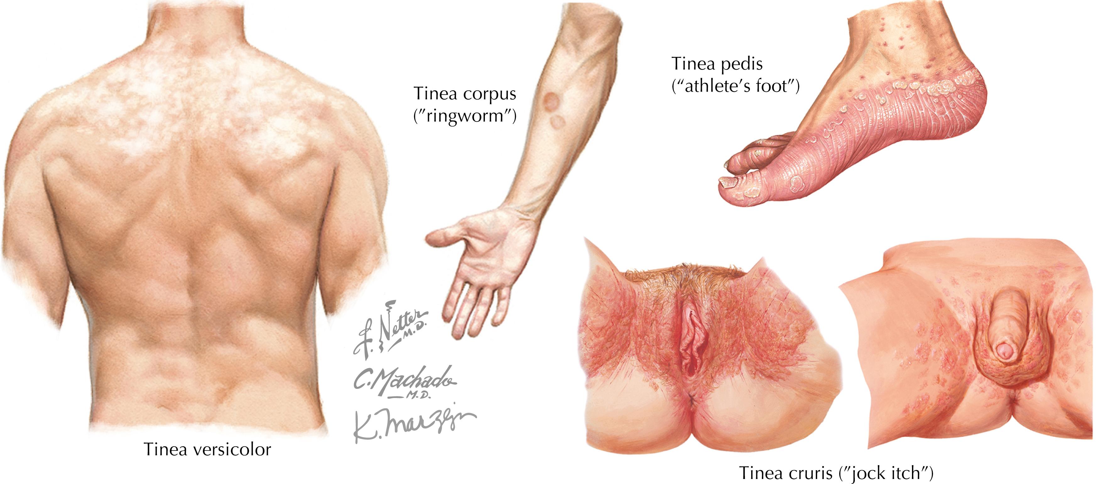 Figure 40.3, Common fungal infections.