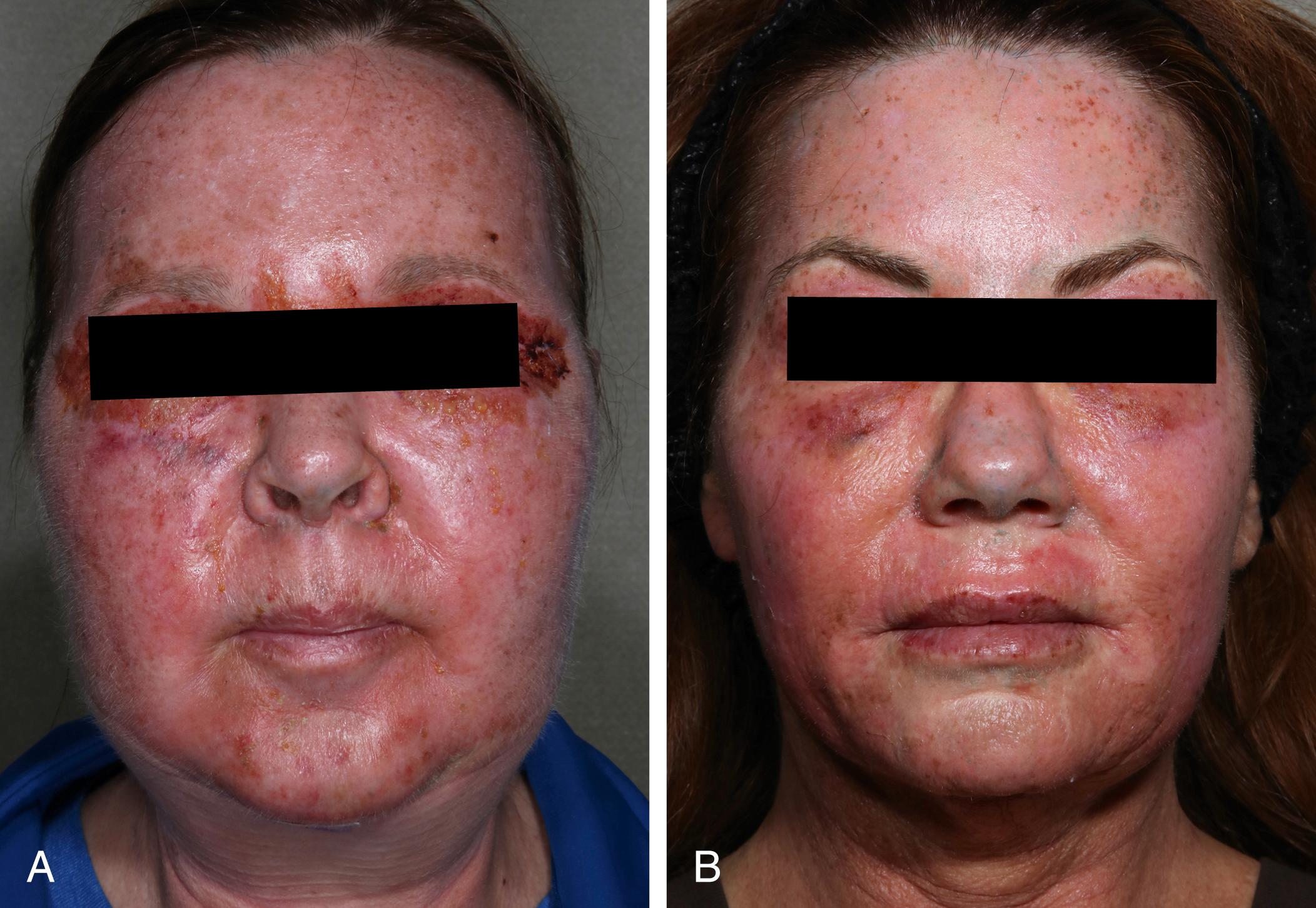 Fig. 16.1, A, Patient is postoperative day 2 following a blue peel, periorbital fractionated laser resurfacing, and an upper eyelift. B, Patient is postoperative day 3 following a blue peel, periorbital fractionated laser resurfacing, and a Hetter VL peel of the cutaneous upper lip.