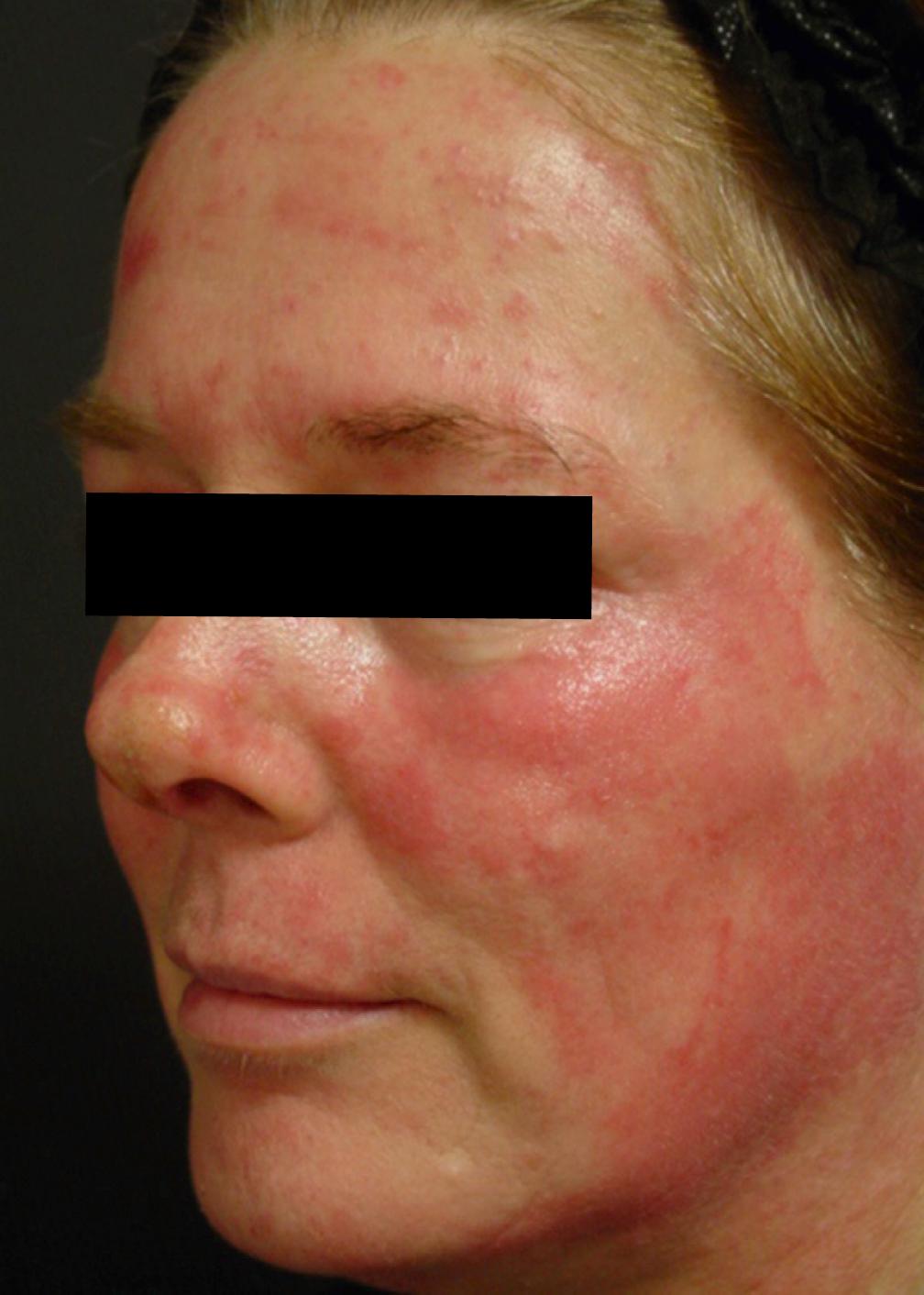 Fig. 16.2, Patient developed contact dermatitis to one of the postoperative products. Her symptoms were pruritus and healing regression manifesting on postoperative day 4 following a blue peel.