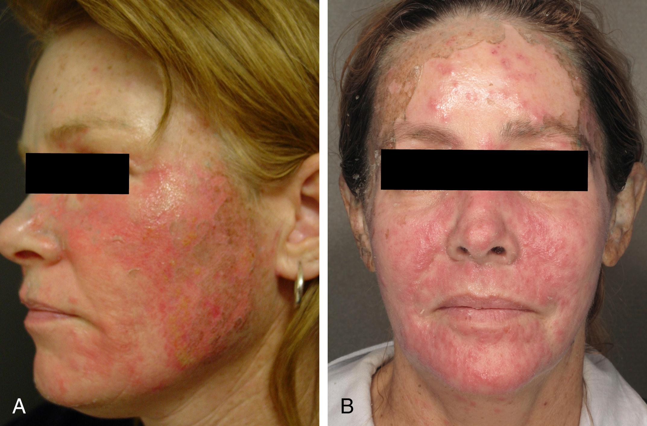 Fig. 16.3, A, Staphylococcus aureus infection manifesting as crusting, tenderness, and healing regression on postoperative day 4. B, Serratia marcescens manifesting as pruritic papules, tenderness, and healing regression on postoperative day 6.