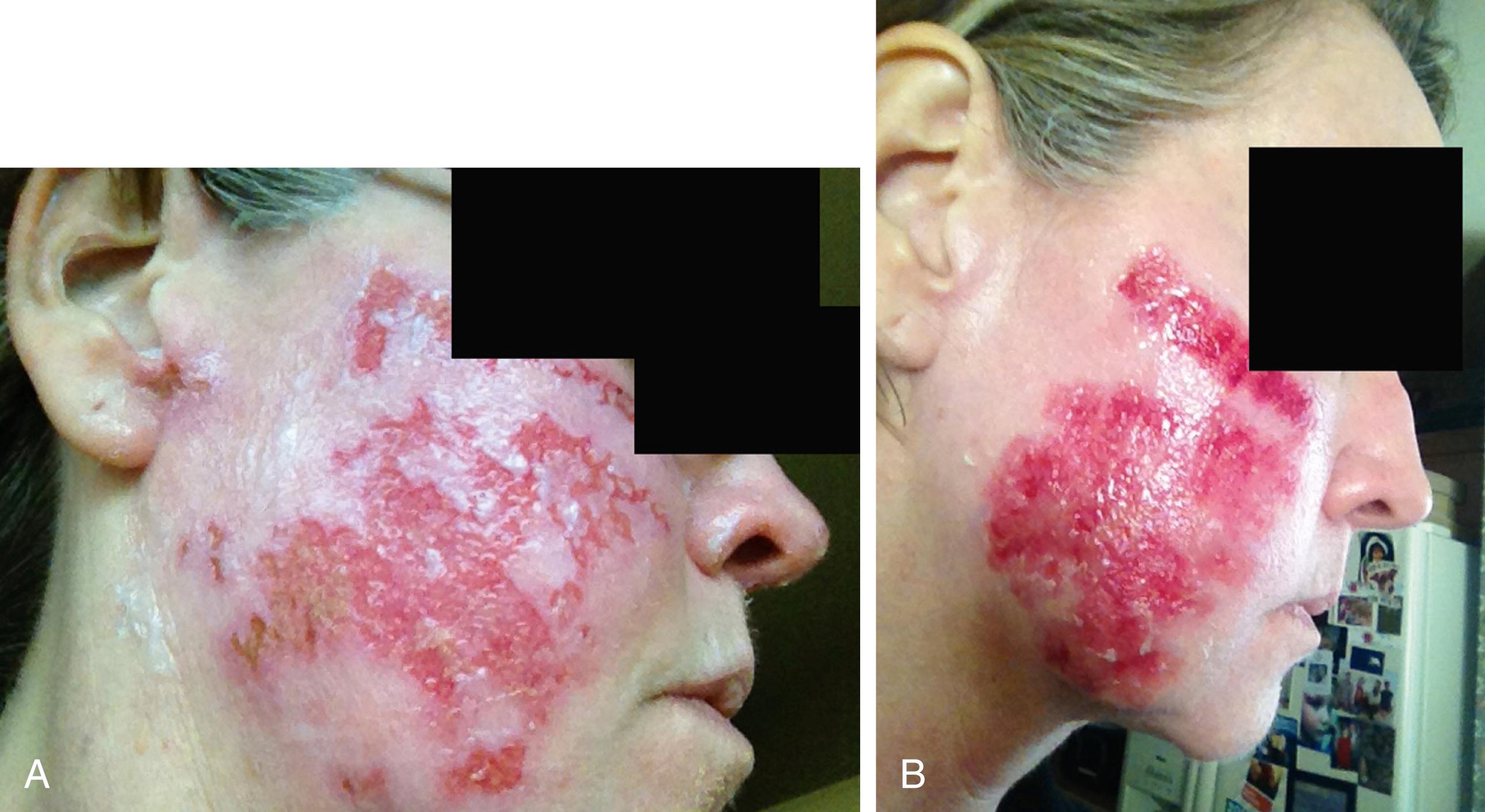 Fig. 16.4, Disseminated viral infection (herpes simplex virus or varicella zoster virus) can manifest aggressively as quickly spreading erosions and ulcerations with a high likelihood to scar if early intervention is missed. A, Patient at postoperative day 5 from a trichloroacetic acid blue peel of the face and a Hetter VL peel of the eyes. B, Same patient several weeks later still with erosions. In between, she developed a secondary S. aureus infection requiring oral antibiotics.