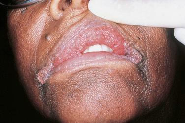 FIGURE 17-1, Mucosal surfaces may be involved in acanthosis nigricans, as demonstrated by this woman with gastric adenocarcinoma.