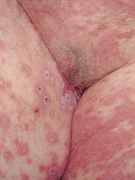 FIGURE 17-4, Paraneoplastic pemphigus. Multiple erythematous papules and vesicles in the groin of this patient.
