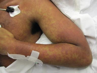 Figure 23.1, DRESS – d rug r eaction with e osinophilia and s ystemic s ymptoms.