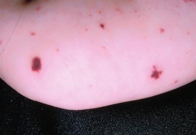 Figure 23.2, Meningococcemia – purpura in an acutely ill patient.