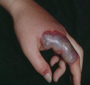 Figure 23.3, Sweet syndrome (acute febrile neutrophilic dermatosis) manifest by a bullous appearing hemorrhagic plaque. This patient had fever, neutrophilia, and acute myelogenous leukemia.