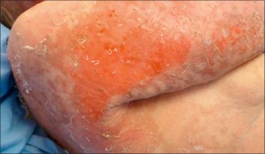 Fig. 15.1, Patient with toxic epidermal necrolysis.