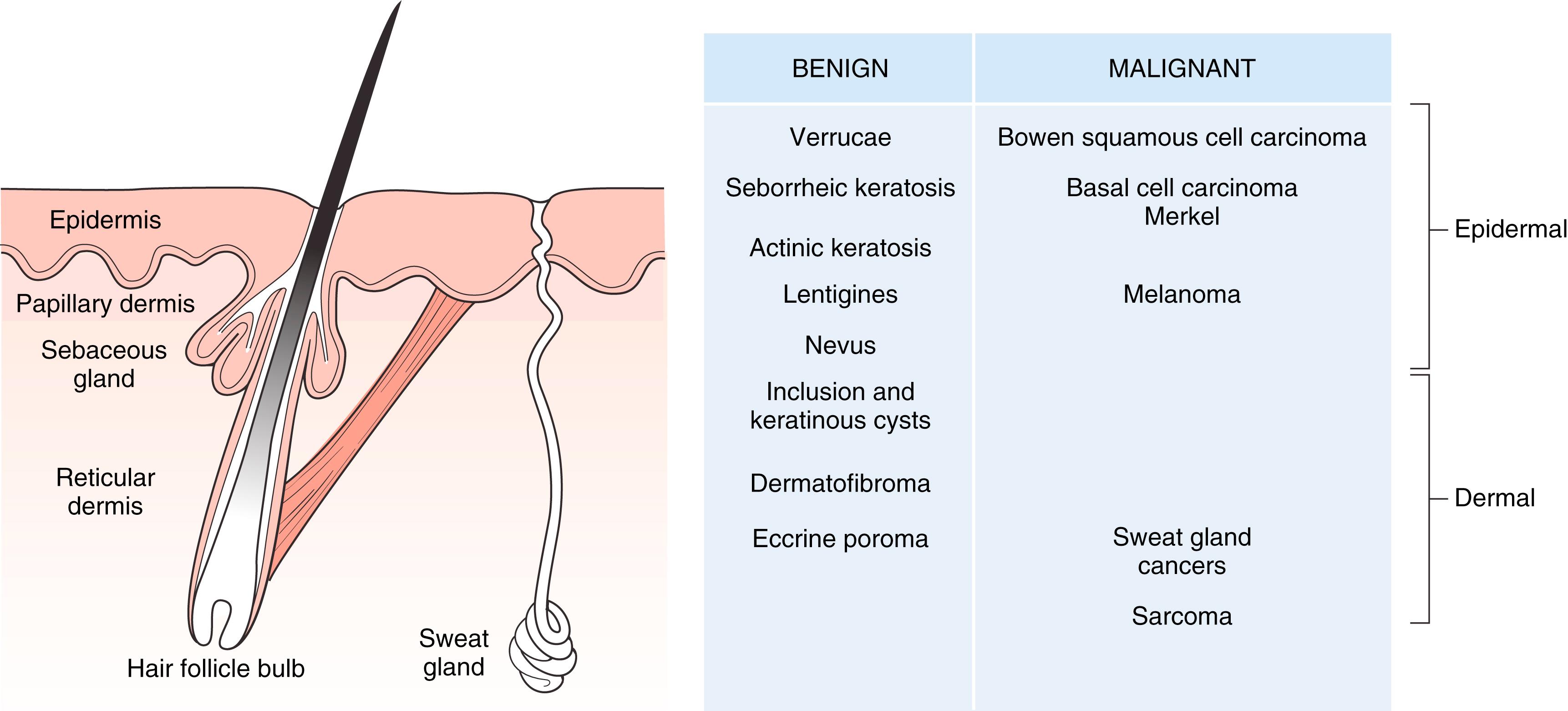 Fig. 58.1, Layers of skin to include adnexal structures and origin of benign and malignant skin tumors.