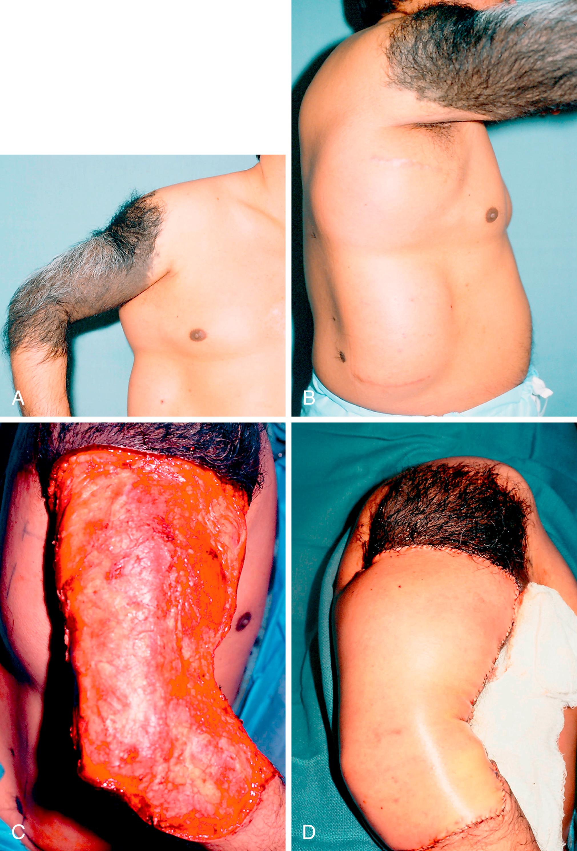 Fig. 58.12, A, Arm giant hairy nevus. B, Large tissue expanders have been placed in the lateral chest wall. C, Most of the lesion is able to be excised at the first stage, and a large wraparound chest wall pedicle flap is used for reconstruction (D) .