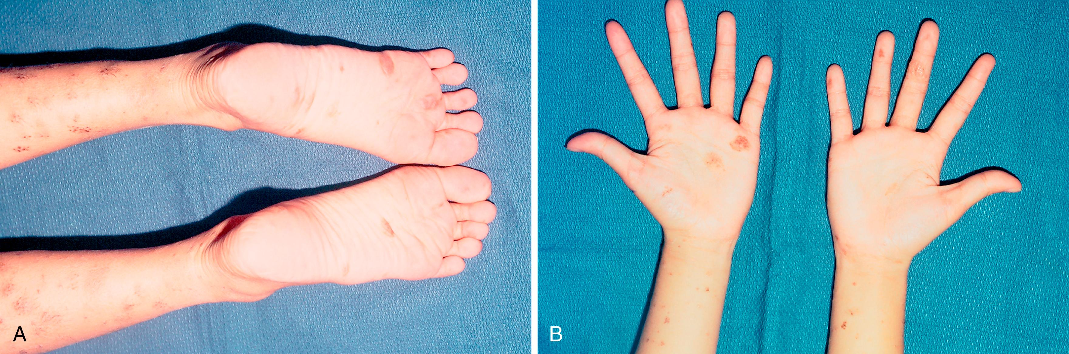 Fig. 58.13, A and B, Child with multiple dysplastic nevi on trunk and upper and lower extremities, including plantar and palmar surfaces (acral nevi).