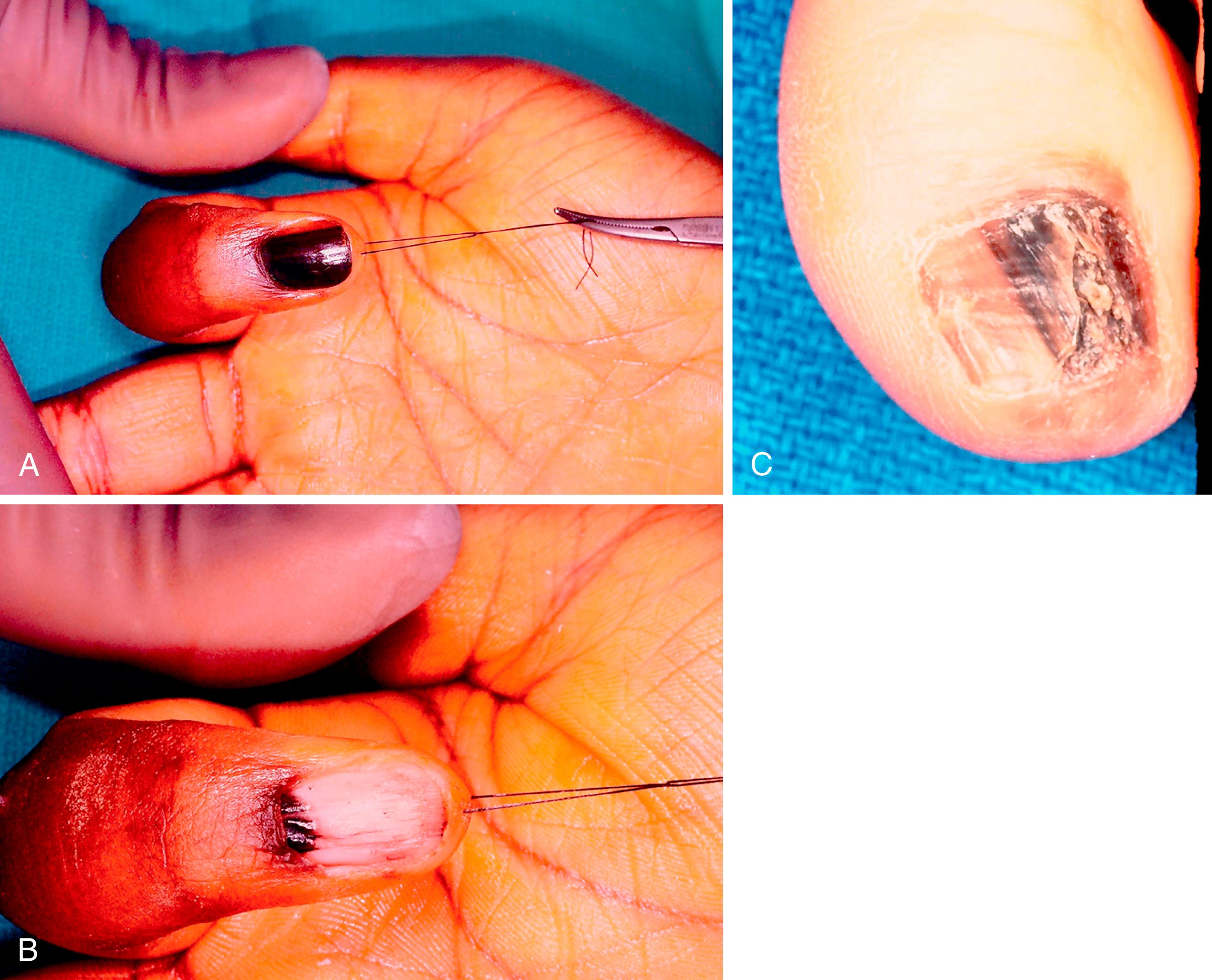 Fig. 58.14, A, Nail has become completely involved by dark pigmentation. B, Nail plate has been removed to reveal germinal matrix nail bed pigmentation. Biopsy showed cellular atypia but no invasive melanoma. This was treated by nail bed surgical ablation and full-thickness skin grafting. C, Subungual melanoma showing Hutchinson sign with pigmentation encroaching on the proximal eponychium.