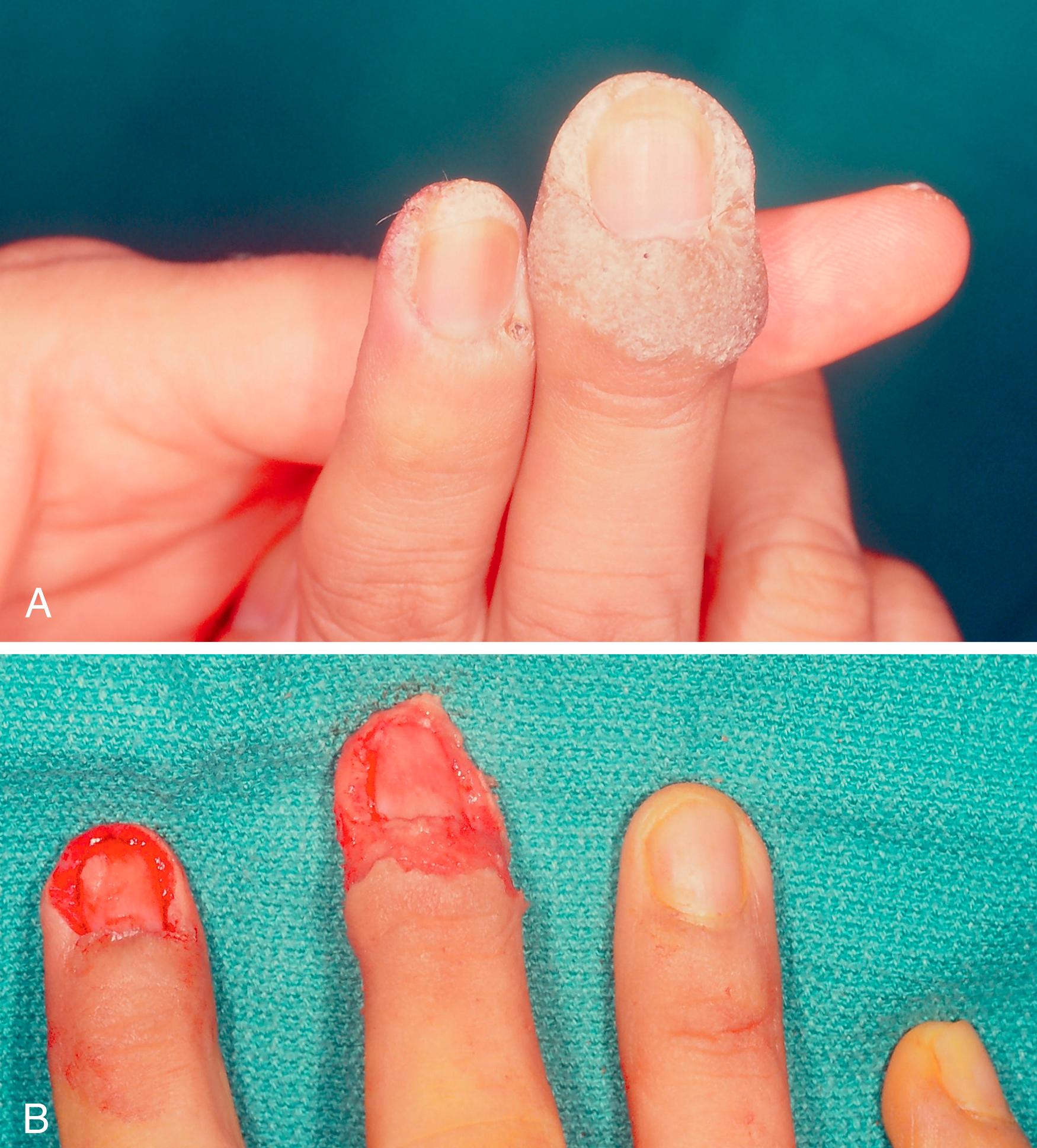 Fig. 58.4, A, Periungual verruca vulgaris on two fingers. B, The lesions have been curettaged after nail plate removal. Reepitheliazation and normal nail growth will follow since the full-thickness epidermis has not been breached.