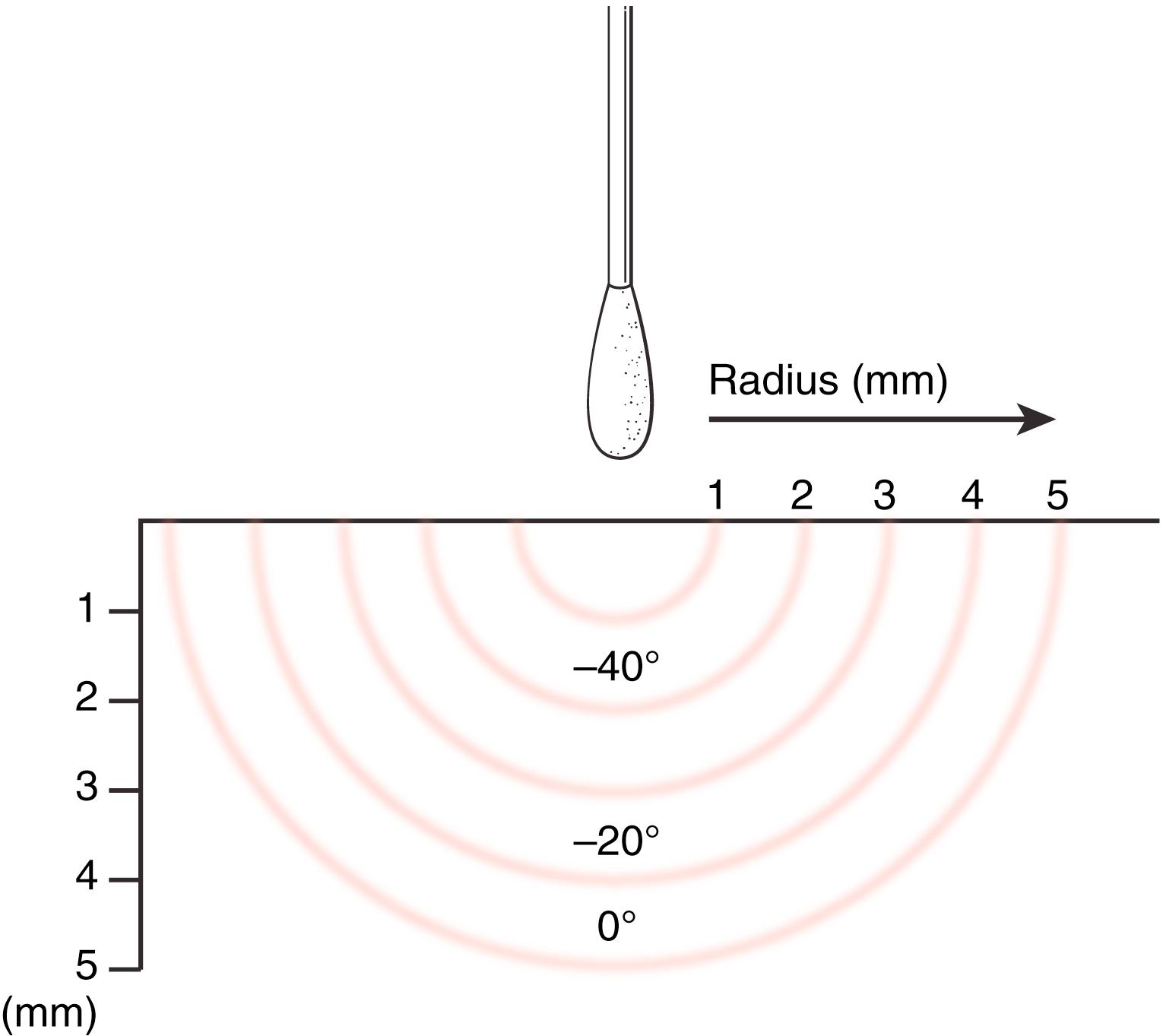 Fig. 58.5, Diagrammatic representation of cryotherapy with cotton-tipped applicator dipped in liquid nitrogen.