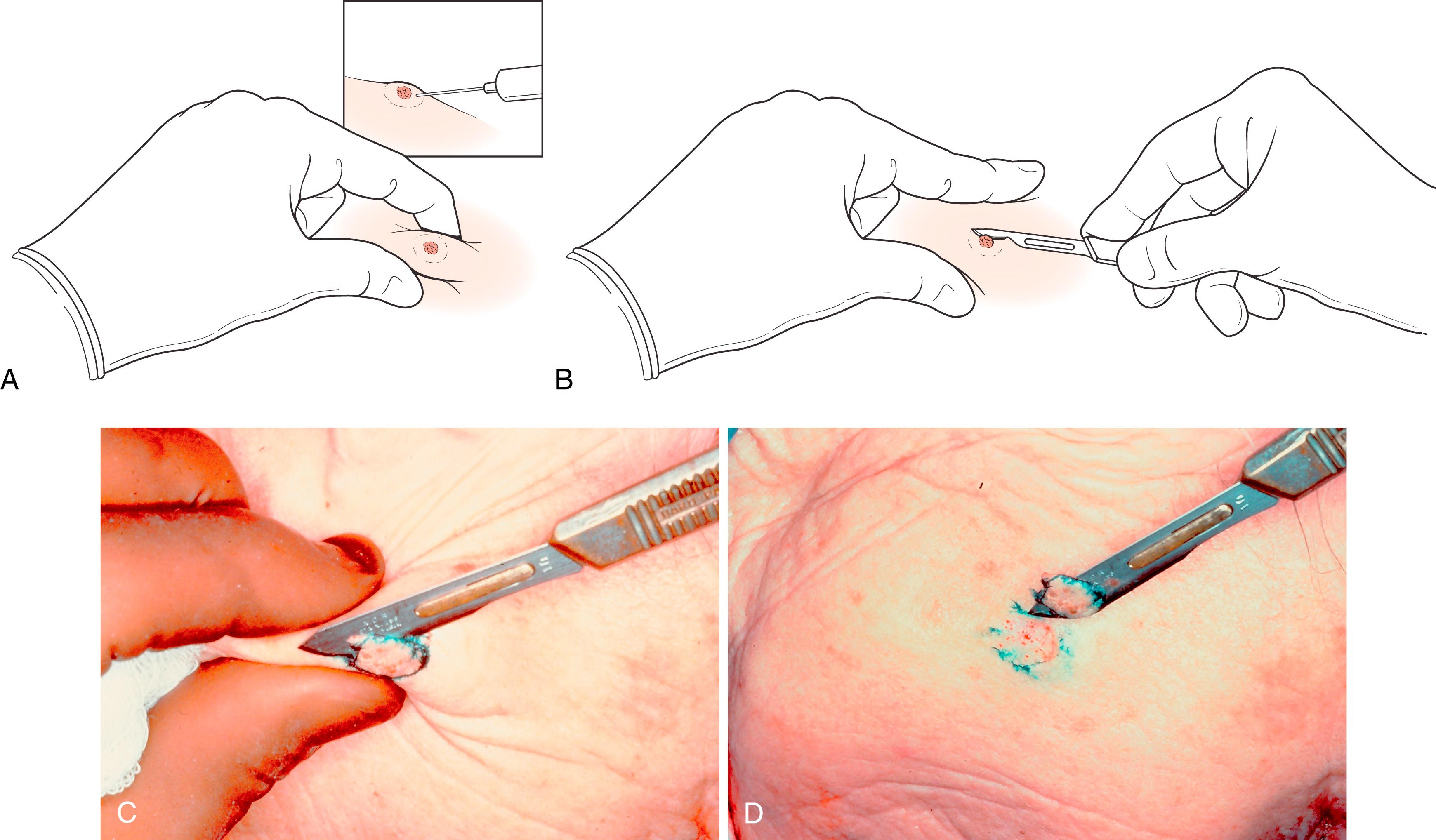 Fig. 58.6, A and B, Diagrammatic illustration of shave biopsy. The lesion is plumped up first by local anesthetic infiltration and then by pinching the skin between index and thumb. Tangential excision of the lesion is thus facilitated. C and D, Clinical demonstration of shave biopsy.