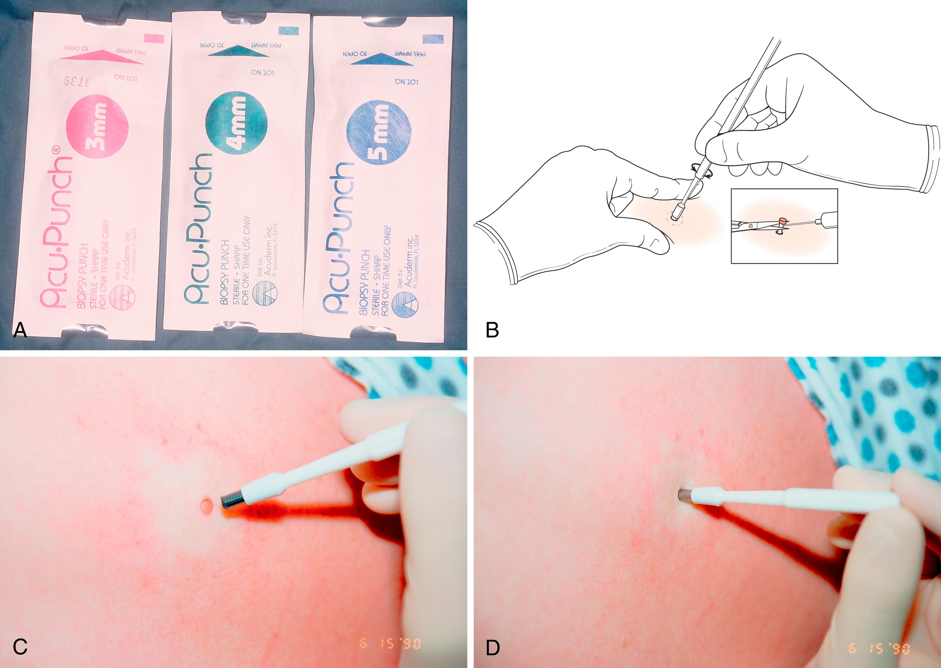 Fig. 58.7, A, Different size punches (3 mm, 4 mm, 5 mm). B, Illustration shows how the cutting punch creates a cylinder of tissue that can then be lifted up and cut loose. C and D, The core of tissue can be lifted up by fine forceps or by piercing it with the tip of a hypodermic needle.