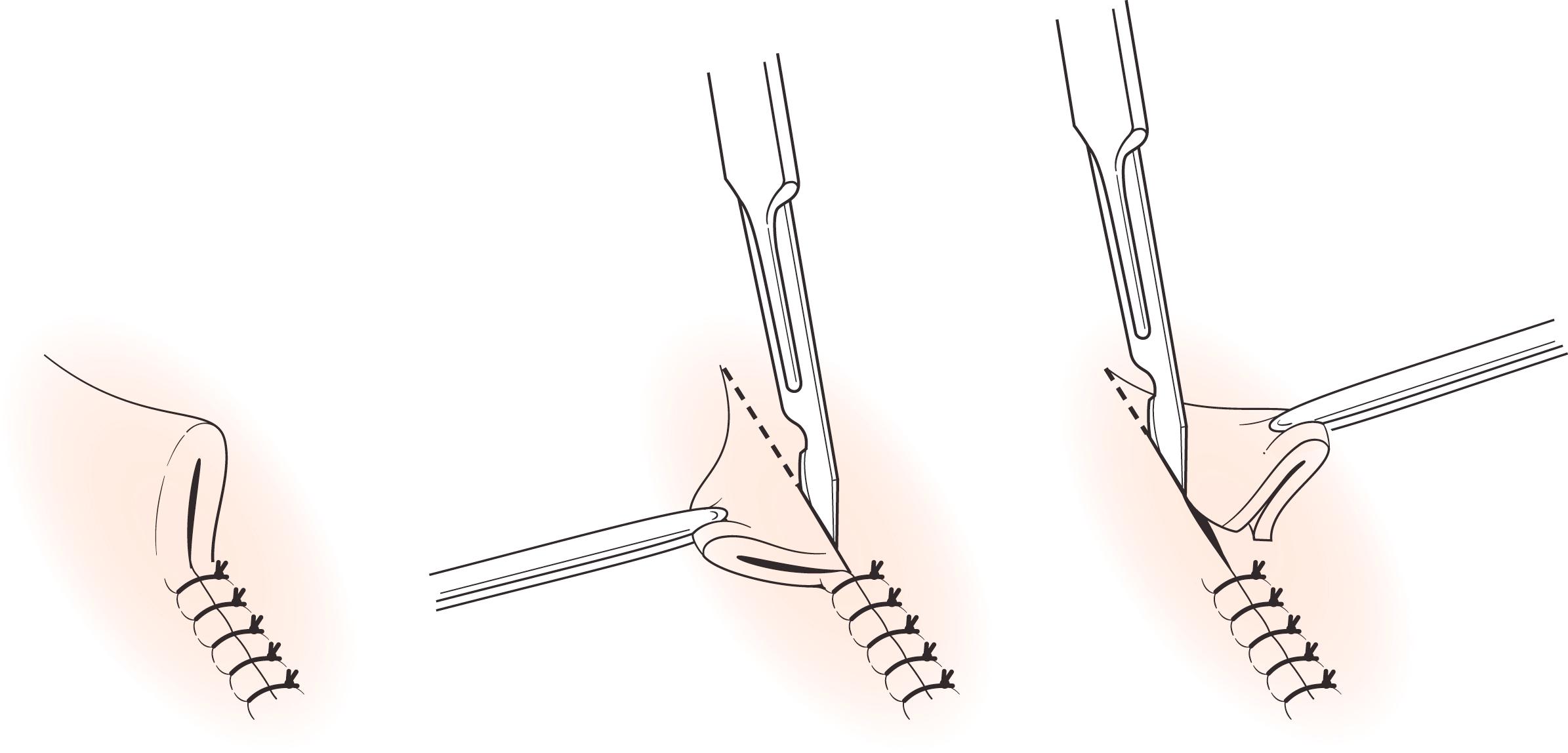 Fig. 58.8, Method of “dog ear” excision following elliptical excision of a lesion.