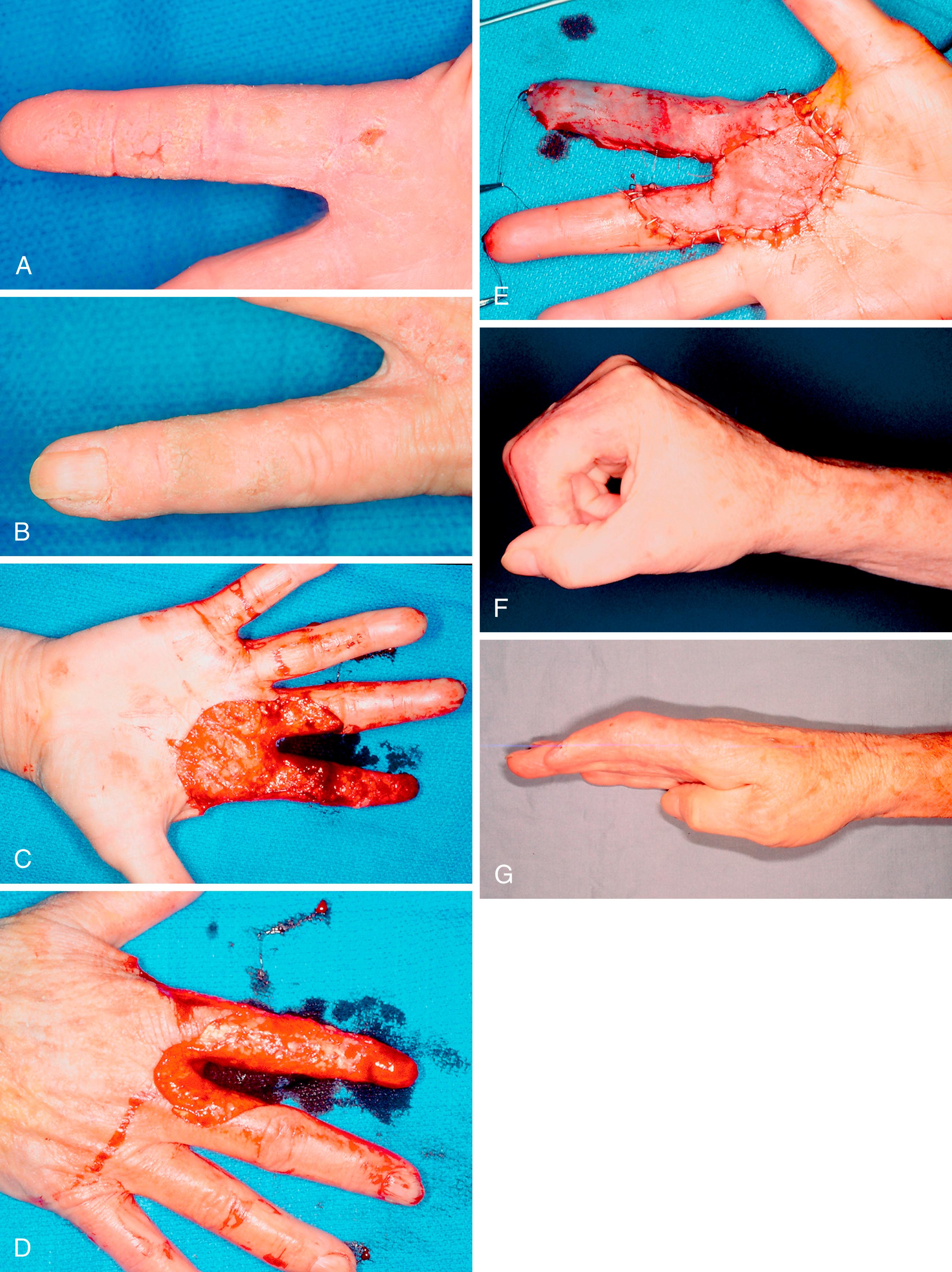 Fig. 58.10, A and B, Bowen carcinoma. It is difficult to define the tumor margins by clinical inspection. Mohs surgery is performed ( C and D ) and skin grafting done (E) , with the long-term outcome shown ( F and G ).