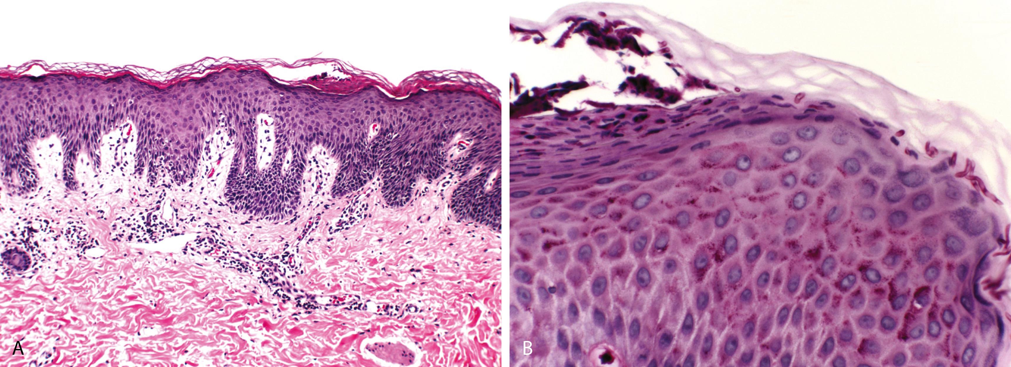 Figure 2.1, Dermatophytosis.