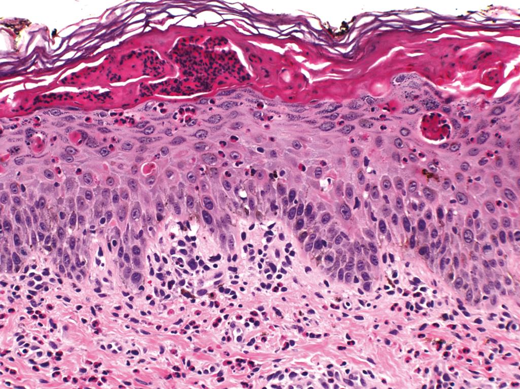 Figure 2.11, Incontinentia pigmenti.