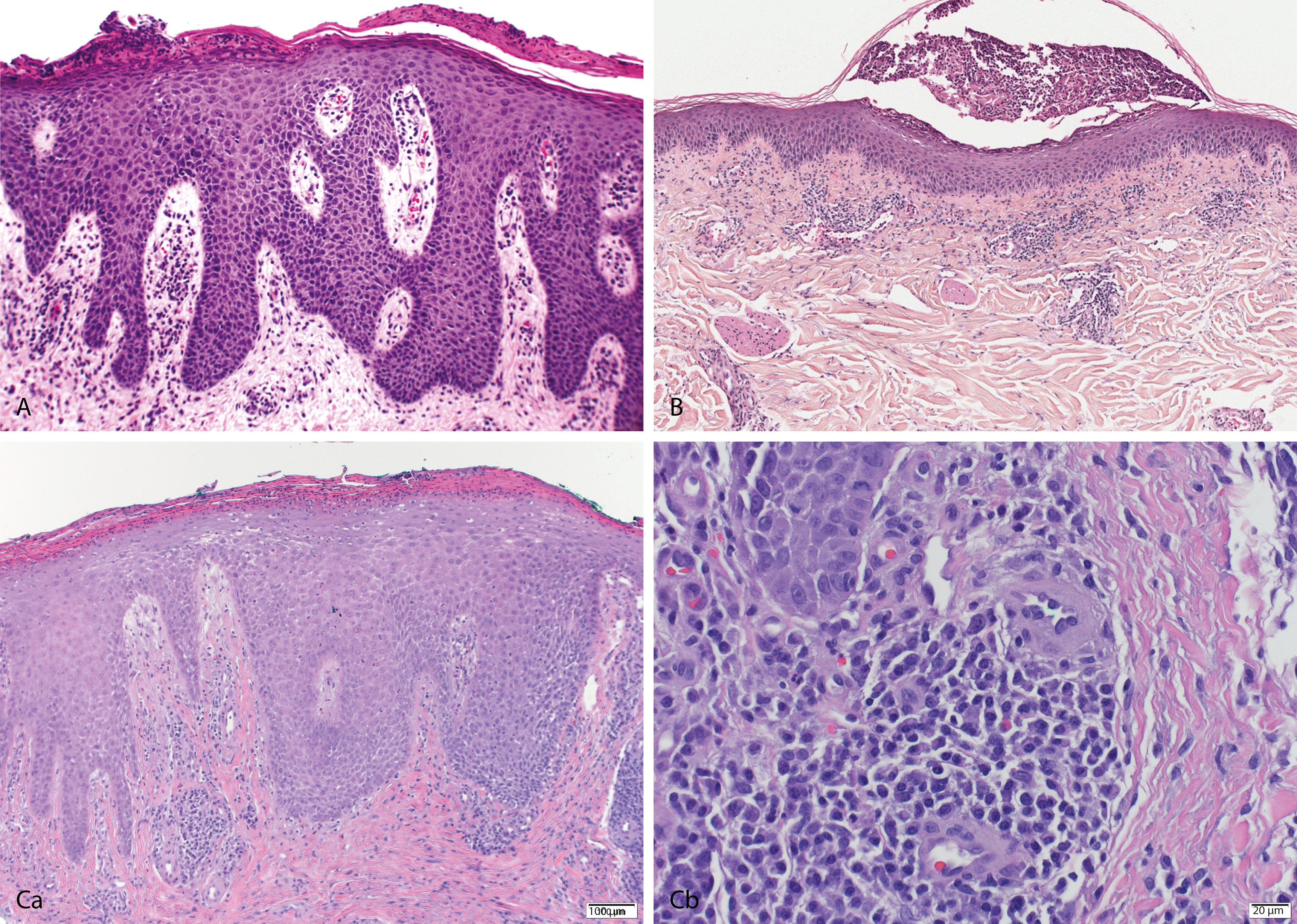 Figure 2.12, A, Psoriasis. Confluent parakeratosis with collections of neutrophils, diminished granular layer, regular (psoriasiform) epidermal hyperplasia with thinning of suprapapillary plates, dilated blood vessels in the papillary dermis, and mild superficial perivascular inflammation are seen. B, Pustular psoriasis. Prominent Munro microabscess. C, AIDS-associated psoriasis. Scale crust with neutrophils, psoriasiform epidermal hyperplasia, absence of thinning of the suprapapillary plate [a], and numerous plasma cells [b].