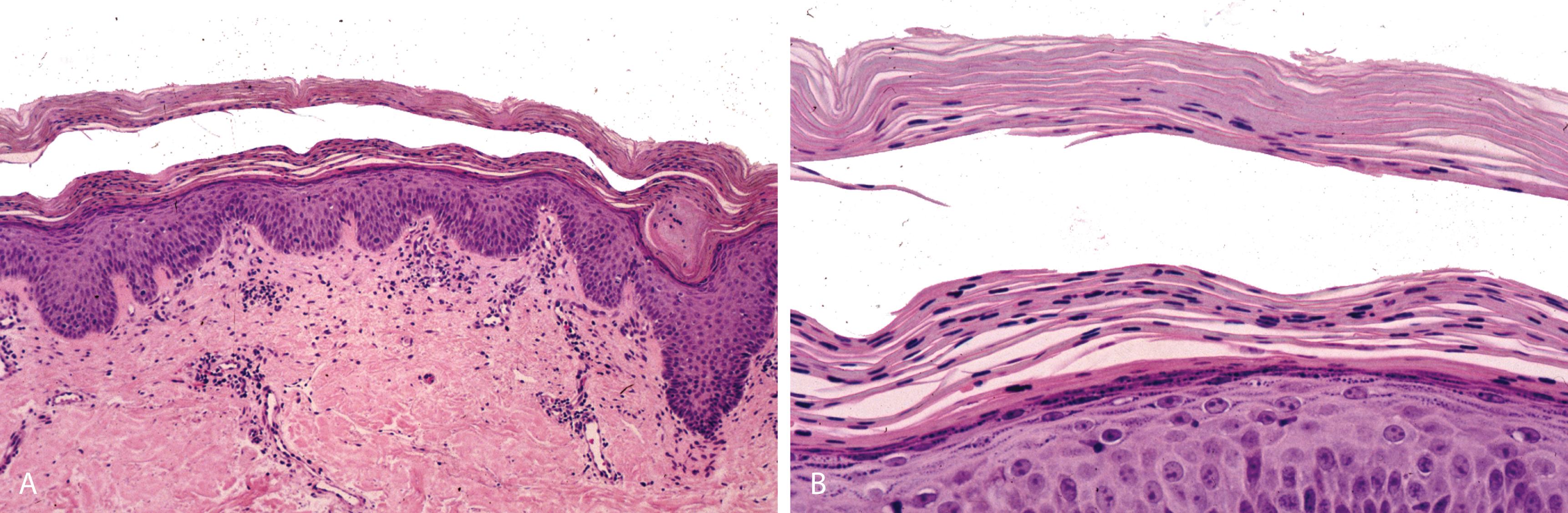 Figure 2.13, Pityriasis rubra pilaris.