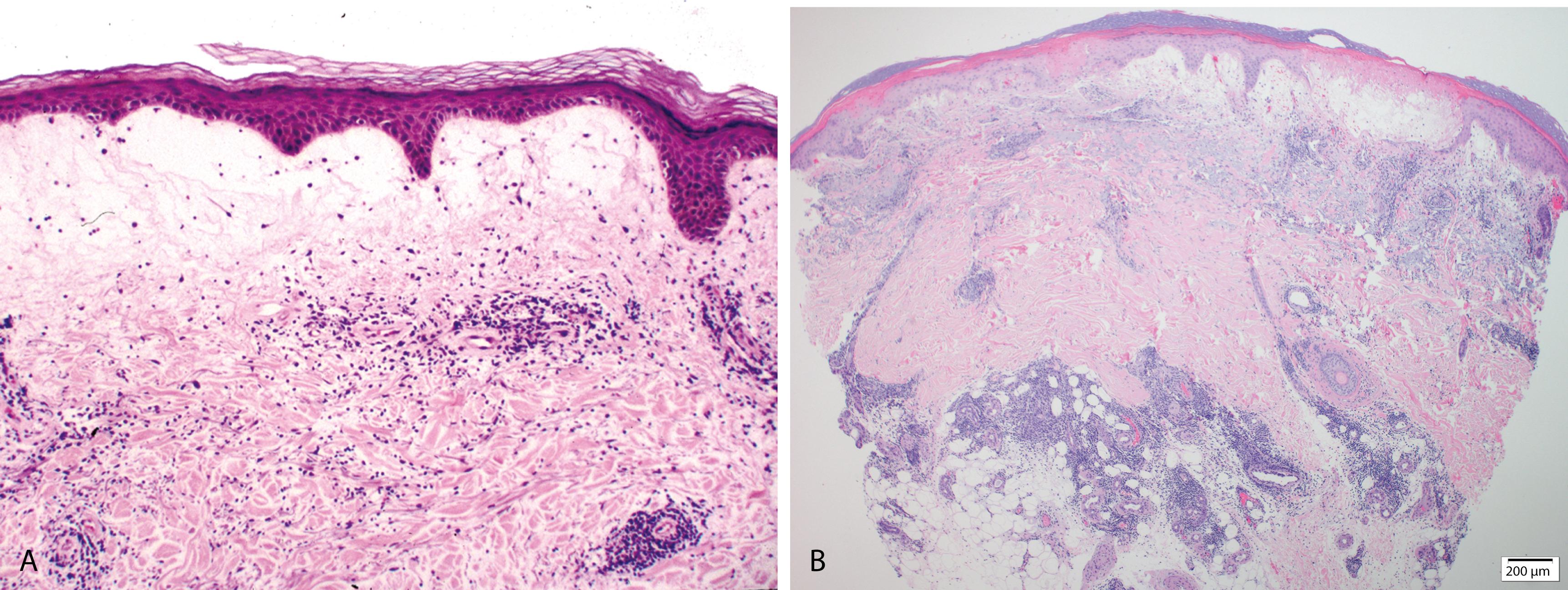 Figure 2.14, A, Polymorphous light eruption. A superficial and deep perivascular lymphocytic infiltrate is associated with marked papillary dermal edema. B, Pernio. Interface change, superficial and deep dermal perivascular and periadnexal inflammation, increased dermal mucin, prominent papillary dermal edema, and extravasated erythrocytes.