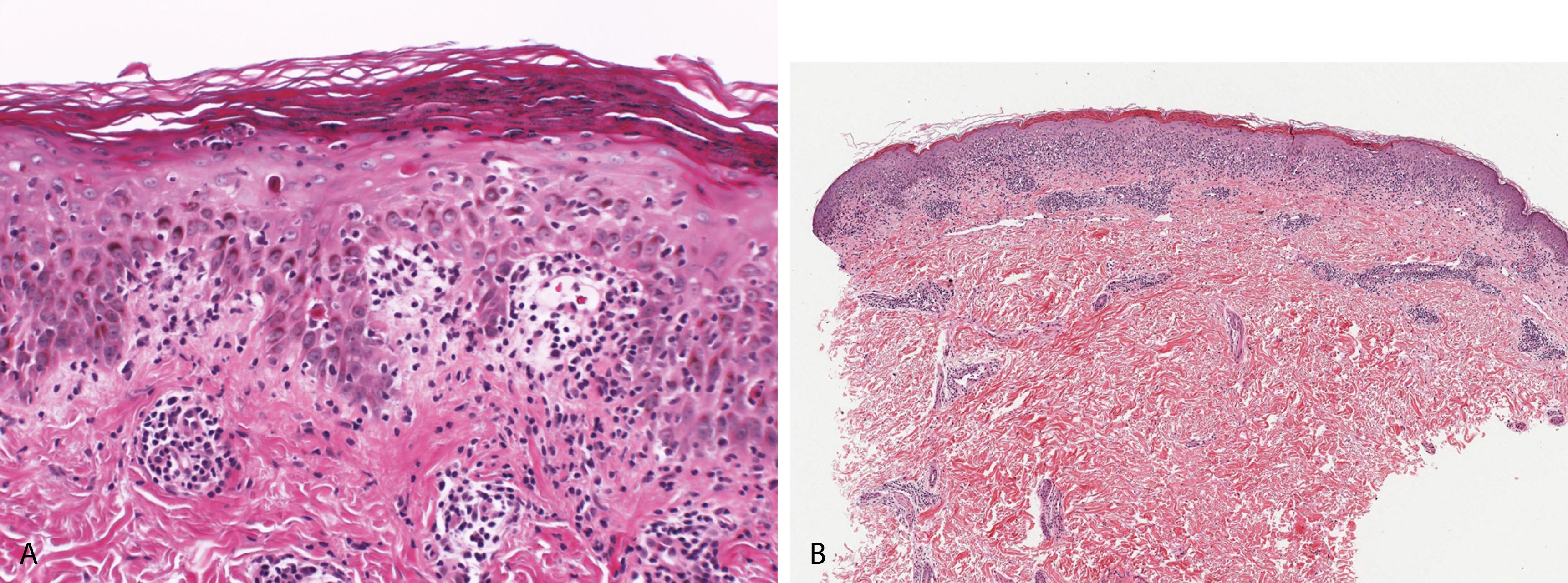 Figure 2.16, A, Pityriasis lichenoides acuta. Parakeratosis containing collections of neutrophils, vacuolar alteration of the basal cell layer, and patchy lichenoid and perivascular lymphocytic inflammation are seen. Scattered necrotic keratinocytes and extravasated red cells are present. B, Pityriasis lichenoides chronica. Hyperkeratosis, parakeratosis, mild epidermal hyperplasia, interface change, and a superficial perivascular lymphohistiocytic infiltrate with extravasated erythrocytes